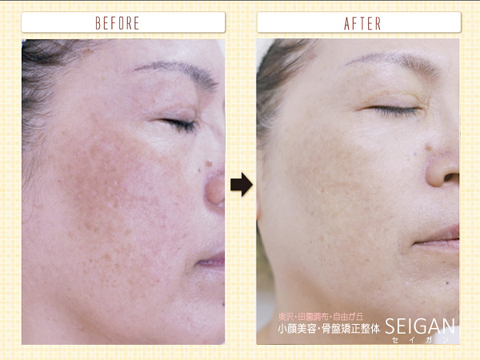 しみーFCRトリートメント効果ビフォーアフター | 東京世田谷区 FCRトリートメント正規店 SEIGAN 【奥沢・田園調布・自由が丘】