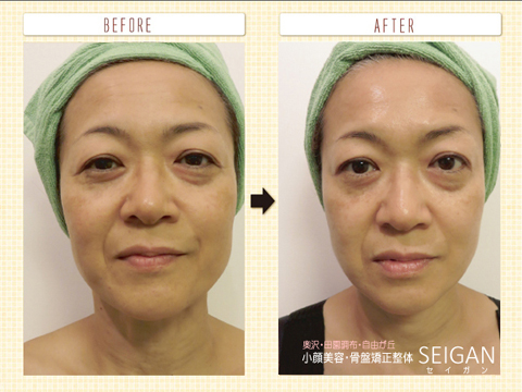 たるみーFCRトリートメント効果ビフォーアフター | 東京世田谷区 FCRトリートメント正規店 SEIGAN 【奥沢・田園調布・自由が丘】