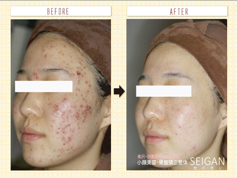 ニキビ・ニキビ跡（痕）ーFCRトリートメント効果ビフォーアフター | 東京世田谷区 FCRトリートメント正規店 SEIGAN 【奥沢・田園調布・自由が丘】