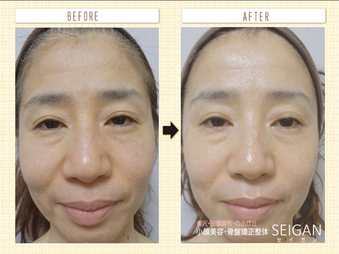 たるみーFCRトリートメント効果ビフォーアフター | 東京世田谷区 FCRトリートメント正規店 SEIGAN 【奥沢・田園調布・自由が丘】