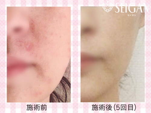 FCRトリートメント効果ビフォーアフター | 東京世田谷区 FCRトリートメント正規店 SEIGAN 【奥沢・田園調布・自由が丘】