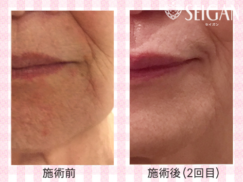 FCRトリートメント効果ビフォーアフター | 東京世田谷区 FCRトリートメント正規店 SEIGAN 【奥沢・田園調布・自由が丘】