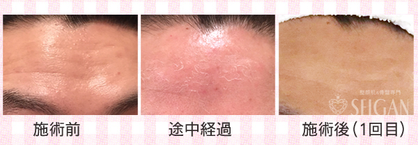 FCRトリートメント効果ビフォーアフター | 東京世田谷区 FCRトリートメント正規店 SEIGAN 【奥沢・田園調布・自由が丘】