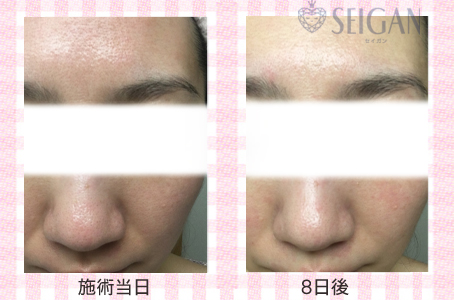 肌質改善・アンチエイジング・ニキビ・ニキビ跡（痕）FCRトリートメントビフォーアフター写真｜FCRハーブトリートメント｜50代・60代・70代から始めるエステ SEIGAN ｾｲｶﾞﾝ 【奥沢・自由が丘・田園調布】
