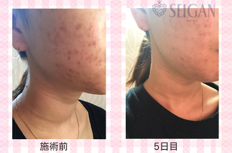 肌質改善・アンチエイジング・ニキビ・ニキビ跡（痕）FCRトリートメントビフォーアフター写真｜FCRハーブトリートメント｜50代・60代・70代から始めるエステ SEIGAN ｾｲｶﾞﾝ 【奥沢・自由が丘・田園調布】