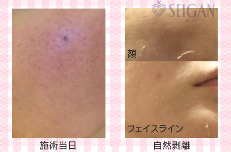 肌質改善・アンチエイジング・ニキビ・ニキビ跡（痕）FCRトリートメントビフォーアフター写真｜FCRハーブトリートメント｜50代・60代・70代から始めるエステ SEIGAN ｾｲｶﾞﾝ 【奥沢・自由が丘・田園調布】