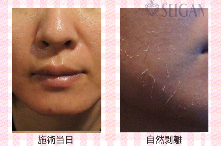 肌質改善・アンチエイジング・ニキビ・ニキビ跡（痕）FCRトリートメントビフォーアフター写真｜FCRハーブトリートメント｜50代・60代・70代から始めるエステ SEIGAN ｾｲｶﾞﾝ 【奥沢・自由が丘・田園調布】