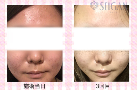 肌質改善・アンチエイジング・ニキビ・ニキビ跡（痕）FCRトリートメントビフォーアフター写真｜FCRハーブトリートメント｜50代・60代・70代から始めるエステ SEIGAN ｾｲｶﾞﾝ 【奥沢・自由が丘・田園調布】