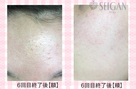 肌質改善・アンチエイジング・ニキビ・ニキビ跡（痕）FCRトリートメントビフォーアフター写真｜FCRハーブトリートメント｜50代・60代・70代から始めるエステ SEIGAN ｾｲｶﾞﾝ 【奥沢・自由が丘・田園調布】