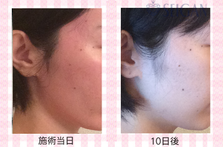 肌質改善・アンチエイジング・ニキビ・ニキビ跡（痕）FCRトリートメントビフォーアフター写真｜FCRハーブトリートメント｜50代・60代・70代から始めるエステ SEIGAN ｾｲｶﾞﾝ 【奥沢・自由が丘・田園調布】