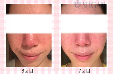 肌質改善・アンチエイジング・ニキビ・ニキビ跡（痕）FCRトリートメントビフォーアフター写真｜FCRハーブトリートメント｜50代・60代・70代から始めるエステ SEIGAN ｾｲｶﾞﾝ 【奥沢・自由が丘・田園調布】