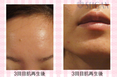 肌質改善・アンチエイジング・ニキビ・ニキビ跡（痕）FCRトリートメントビフォーアフター写真｜FCRハーブトリートメント｜50代・60代・70代から始めるエステ SEIGAN ｾｲｶﾞﾝ 【奥沢・自由が丘・田園調布】