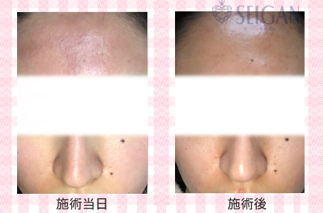 肌質改善・アンチエイジング・ニキビ・ニキビ跡（痕）FCRトリートメントビフォーアフター写真｜FCRハーブトリートメント｜50代・60代・70代から始めるエステ SEIGAN ｾｲｶﾞﾝ 【奥沢・自由が丘・田園調布】