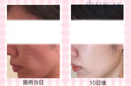 肌質改善・アンチエイジング・ニキビ・ニキビ跡（痕）FCRトリートメントビフォーアフター写真｜FCRハーブトリートメント｜50代・60代・70代から始めるエステ SEIGAN ｾｲｶﾞﾝ 【奥沢・自由が丘・田園調布】