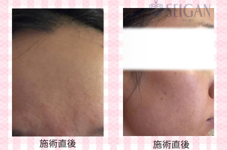 肌質改善・アンチエイジング・ニキビ・ニキビ跡（痕）FCRトリートメントビフォーアフター写真｜FCRハーブトリートメント｜50代・60代・70代から始めるエステ SEIGAN ｾｲｶﾞﾝ 【奥沢・自由が丘・田園調布】