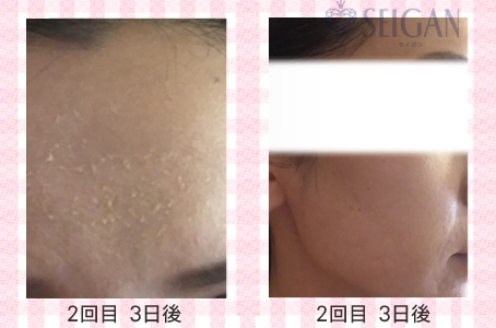 肌質改善・アンチエイジング・ニキビ・ニキビ跡（痕）FCRトリートメントビフォーアフター写真｜FCRハーブトリートメント｜50代・60代・70代から始めるエステ SEIGAN ｾｲｶﾞﾝ 【奥沢・自由が丘・田園調布】