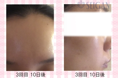 肌質改善・アンチエイジング・ニキビ・ニキビ跡（痕）FCRトリートメントビフォーアフター写真｜FCRハーブトリートメント｜50代・60代・70代から始めるエステ SEIGAN ｾｲｶﾞﾝ 【奥沢・自由が丘・田園調布】