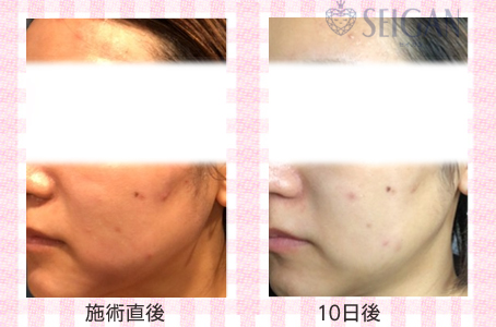 肌質改善・アンチエイジング・ニキビ・ニキビ跡（痕）FCRトリートメントビフォーアフター写真｜FCRハーブトリートメント｜50代・60代・70代から始めるエステ SEIGAN ｾｲｶﾞﾝ 【奥沢・自由が丘・田園調布】