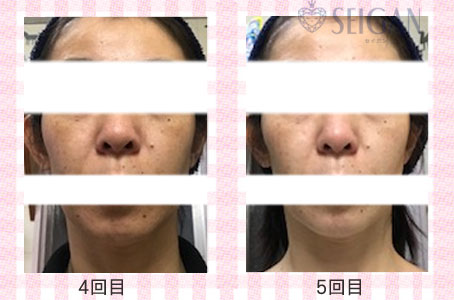 肌質改善・アンチエイジング・ニキビ・ニキビ跡（痕）FCRトリートメントビフォーアフター写真｜FCRハーブトリートメント｜50代・60代・70代から始めるエステ SEIGAN ｾｲｶﾞﾝ 【奥沢・自由が丘・田園調布】
