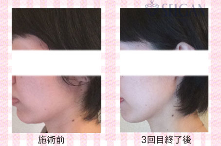 肌質改善・アンチエイジング・ニキビ・ニキビ跡（痕）FCRトリートメントビフォーアフター写真｜FCRハーブトリートメント｜50代・60代・70代から始めるエステ SEIGAN ｾｲｶﾞﾝ 【奥沢・自由が丘・田園調布】