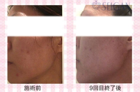 肌質改善・アンチエイジング・ニキビ・ニキビ跡（痕）FCRトリートメントビフォーアフター写真｜FCRハーブトリートメント｜50代・60代・70代から始めるエステ SEIGAN ｾｲｶﾞﾝ 【奥沢・自由が丘・田園調布】