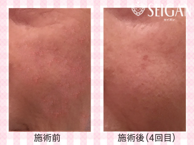 ストレス性の湿疹ビフォーアフター写真｜FCRハーブトリートメント｜50代・60代・70代から始めるエステ SEIGAN ｾｲｶﾞﾝ 【奥沢・田園調布・自由が丘】