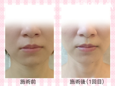 ニキビ・ニキビ跡（痕）ビフォーアフター写真｜FCRハーブトリートメント｜50代・60代・70代から始めるエステ SEIGAN ｾｲｶﾞﾝ 【奥沢・自由が丘・田園調布】