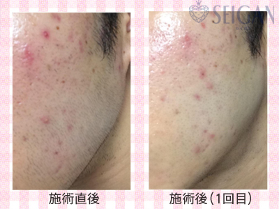 ニキビ・ニキビ跡（痕）ビフォーアフター写真｜FCRハーブトリートメント｜50代・60代・70代から始めるエステ SEIGAN ｾｲｶﾞﾝ 【奥沢・自由が丘・田園調布】