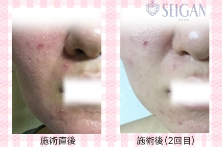 ニキビ・ニキビ跡（痕）ビフォーアフター写真｜FCRハーブトリートメント｜50代・60代・70代から始めるエステ SEIGAN ｾｲｶﾞﾝ 【奥沢・自由が丘・田園調布】