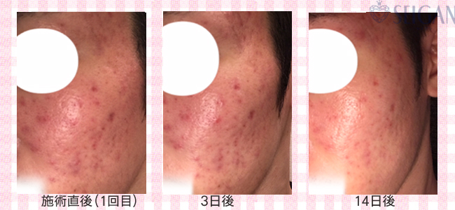 ニキビ・ニキビ跡（痕）ビフォーアフター写真｜FCRハーブトリートメント｜50代・60代・70代から始めるエステ SEIGAN ｾｲｶﾞﾝ 【奥沢・自由が丘・田園調布】