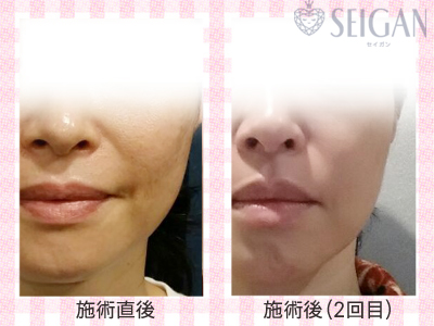 肌質改善・アンチエイジング・ニキビ・ニキビ跡（痕）ビフォーアフター写真｜FCRハーブトリートメント｜50代・60代・70代から始めるエステ SEIGAN ｾｲｶﾞﾝ 【奥沢・自由が丘・田園調布】
