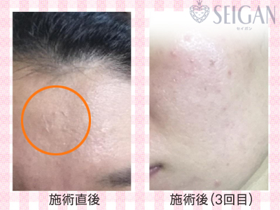 肌質改善・アンチエイジング・ニキビ・ニキビ跡（痕）ビフォーアフター写真｜FCRハーブトリートメント｜50代・60代・70代から始めるエステ SEIGAN ｾｲｶﾞﾝ 【奥沢・自由が丘・田園調布】