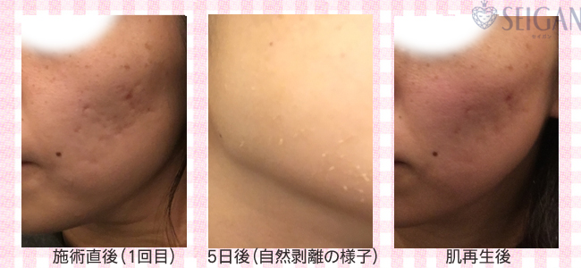 肌質改善・アンチエイジング・ニキビ・ニキビ跡（痕）FCRトリートメントビフォーアフター写真｜FCRハーブトリートメント｜50代・60代・70代から始めるエステ SEIGAN ｾｲｶﾞﾝ 【奥沢・自由が丘・田園調布】