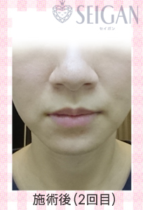 肌質改善・アンチエイジング・ニキビ・ニキビ跡（痕）FCRトリートメントビフォーアフター写真｜FCRハーブトリートメント｜50代・60代・70代から始めるエステ SEIGAN ｾｲｶﾞﾝ 【奥沢・自由が丘・田園調布】