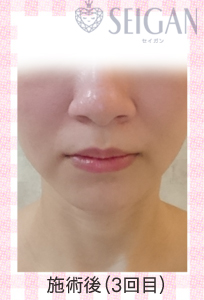 肌質改善・アンチエイジング・ニキビ・ニキビ跡（痕）FCRトリートメントビフォーアフター写真｜FCRハーブトリートメント｜50代・60代・70代から始めるエステ SEIGAN ｾｲｶﾞﾝ 【奥沢・自由が丘・田園調布】