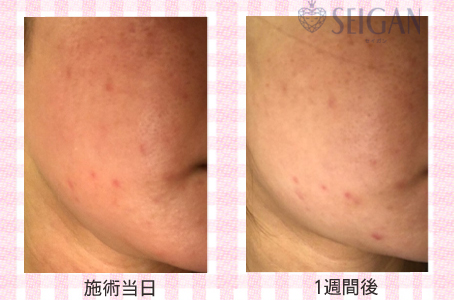 肌質改善・アンチエイジング・ニキビ・ニキビ跡（痕）FCRトリートメントビフォーアフター写真｜FCRハーブトリートメント｜50代・60代・70代から始めるエステ SEIGAN ｾｲｶﾞﾝ 【奥沢・自由が丘・田園調布】