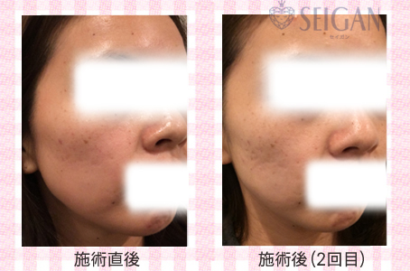 肌質改善・アンチエイジング・ニキビ・ニキビ跡（痕）FCRトリートメントビフォーアフター写真｜FCRハーブトリートメント｜50代・60代・70代から始めるエステ SEIGAN ｾｲｶﾞﾝ 【奥沢・自由が丘・田園調布】