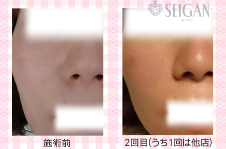 肌質改善・アンチエイジング・ニキビ・ニキビ跡（痕）FCRトリートメントビフォーアフター写真｜FCRハーブトリートメント｜50代・60代・70代から始めるエステ SEIGAN ｾｲｶﾞﾝ 【奥沢・自由が丘・田園調布】