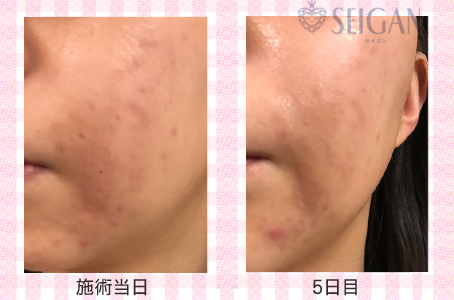肌質改善・アンチエイジング・ニキビ・ニキビ跡（痕）FCRトリートメントビフォーアフター写真｜FCRハーブトリートメント｜50代・60代・70代から始めるエステ SEIGAN ｾｲｶﾞﾝ 【奥沢・自由が丘・田園調布】