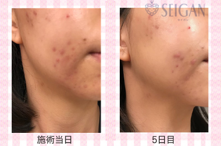 肌質改善・アンチエイジング・ニキビ・ニキビ跡（痕）FCRトリートメントビフォーアフター写真｜FCRハーブトリートメント｜50代・60代・70代から始めるエステ SEIGAN ｾｲｶﾞﾝ 【奥沢・自由が丘・田園調布】