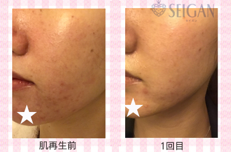 肌質改善・アンチエイジング・ニキビ・ニキビ跡（痕）FCRトリートメントビフォーアフター写真｜FCRハーブトリートメント｜50代・60代・70代から始めるエステ SEIGAN ｾｲｶﾞﾝ 【奥沢・自由が丘・田園調布】