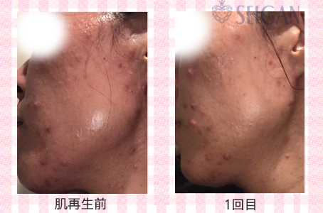 肌質改善・アンチエイジング・ニキビ・ニキビ跡（痕）FCRトリートメントビフォーアフター写真｜FCRハーブトリートメント｜50代・60代・70代から始めるエステ SEIGAN ｾｲｶﾞﾝ 【奥沢・自由が丘・田園調布】