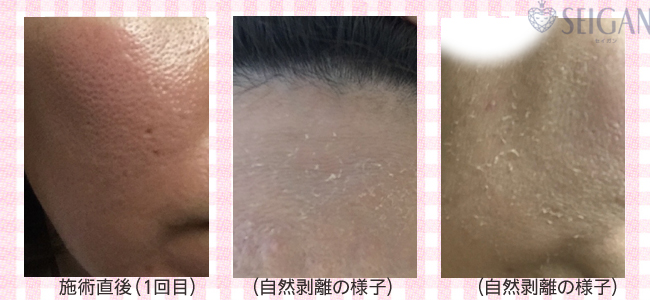 肌質改善・アンチエイジング・ニキビ・ニキビ跡（痕）FCRトリートメントビフォーアフター写真｜FCRハーブトリートメント｜50代・60代・70代から始めるエステ SEIGAN ｾｲｶﾞﾝ 【奥沢・自由が丘・田園調布】