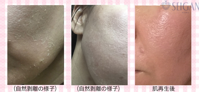 肌質改善・アンチエイジング・ニキビ・ニキビ跡（痕）FCRトリートメントビフォーアフター写真｜FCRハーブトリートメント｜50代・60代・70代から始めるエステ SEIGAN ｾｲｶﾞﾝ 【奥沢・自由が丘・田園調布】