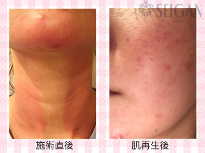 肌質改善・アンチエイジング・ニキビ・ニキビ跡（痕）FCRトリートメントビフォーアフター写真｜FCRハーブトリートメント｜50代・60代・70代から始めるエステ SEIGAN ｾｲｶﾞﾝ 【奥沢・自由が丘・田園調布】