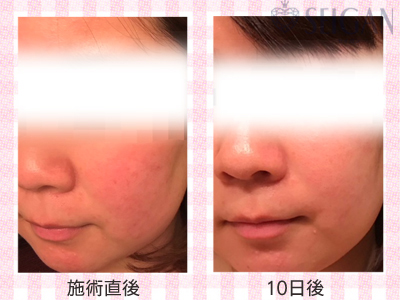 肌質改善・アンチエイジング・ニキビ・ニキビ跡（痕）FCRトリートメントビフォーアフター写真｜FCRハーブトリートメント｜50代・60代・70代から始めるエステ SEIGAN ｾｲｶﾞﾝ 【奥沢・自由が丘・田園調布】