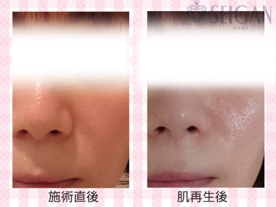 肌質改善・アンチエイジング・ニキビ・ニキビ跡（痕）FCRトリートメントビフォーアフター写真｜FCRハーブトリートメント｜50代・60代・70代から始めるエステ SEIGAN ｾｲｶﾞﾝ 【奥沢・自由が丘・田園調布】