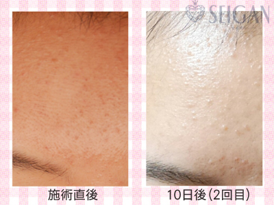 肌質改善・アンチエイジング・ニキビ・ニキビ跡（痕）FCRトリートメントビフォーアフター写真｜FCRハーブトリートメント｜50代・60代・70代から始めるエステ SEIGAN ｾｲｶﾞﾝ 【奥沢・自由が丘・田園調布】