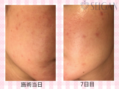 肌質改善・アンチエイジング・ニキビ・ニキビ跡（痕）FCRトリートメントビフォーアフター写真｜FCRハーブトリートメント｜50代・60代・70代から始めるエステ SEIGAN ｾｲｶﾞﾝ 【奥沢・自由が丘・田園調布】