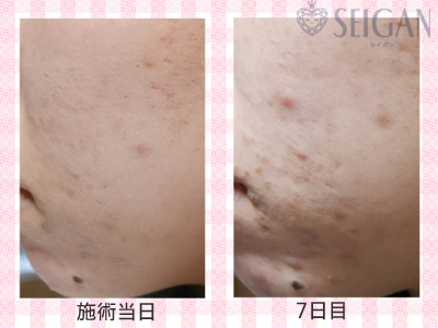 肌質改善・アンチエイジング・ニキビ・ニキビ跡（痕）FCRトリートメントビフォーアフター写真｜FCRハーブトリートメント｜50代・60代・70代から始めるエステ SEIGAN ｾｲｶﾞﾝ 【奥沢・自由が丘・田園調布】